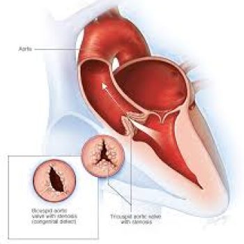 aortic_stenosis